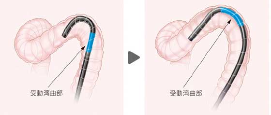 使い捨てマウスピース