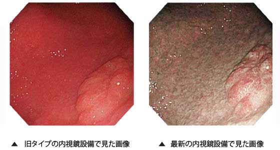使い捨てマウスピース